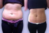 LIPO SEM CORTES